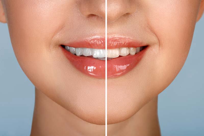 Teeth Whitening Ottawa